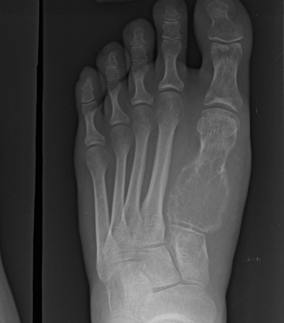 Foot Aneurysmal Bone Cyst